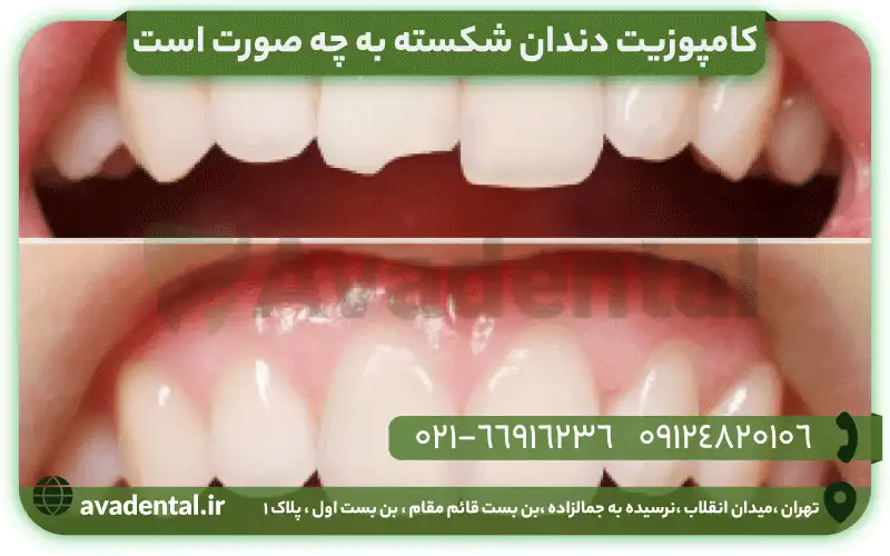 کامپوزیت دندان شکسته