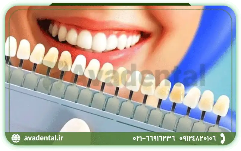 کامپوزیت دندانپزشکی را بهتر بشناسید