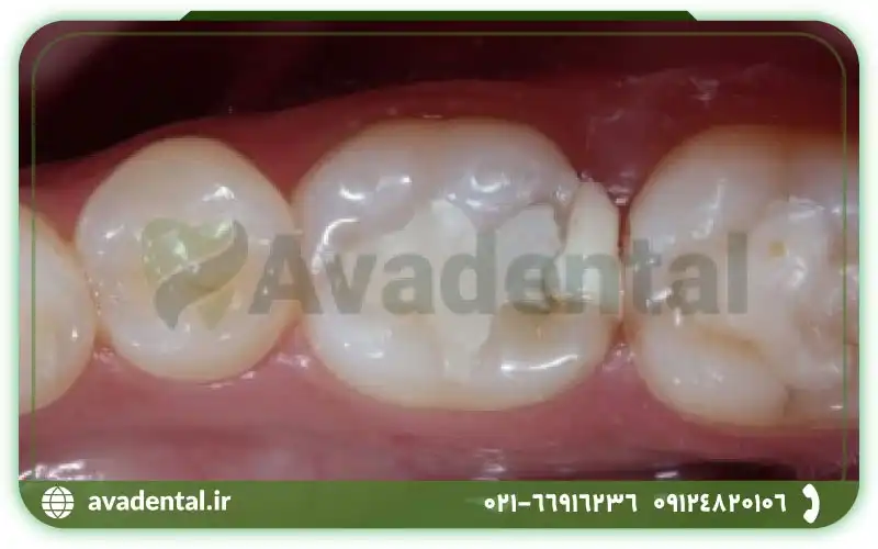 کویت دندانپزشکی چیست و از چه موادی تولید می شود؟