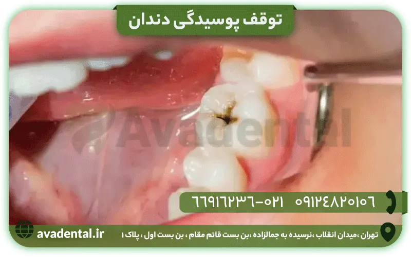 توقف پوسیدگی دندان