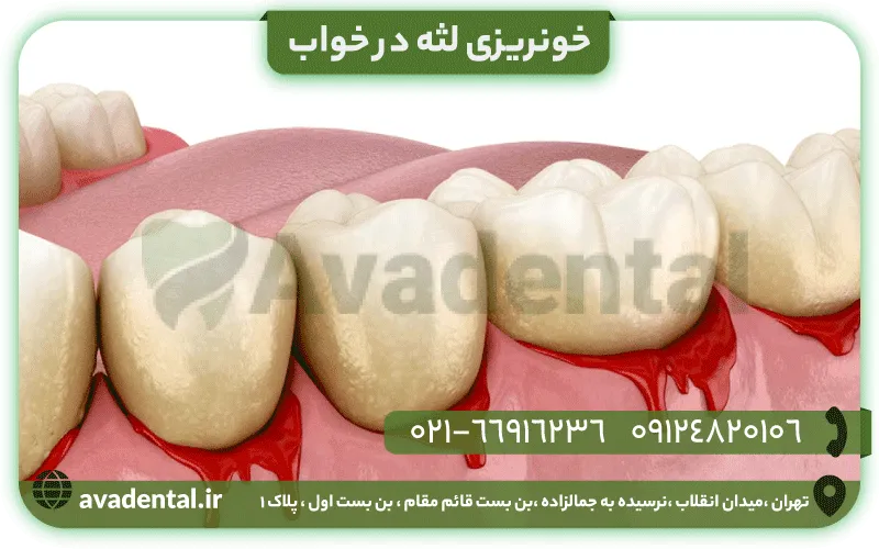 خونریزی لثه در خواب