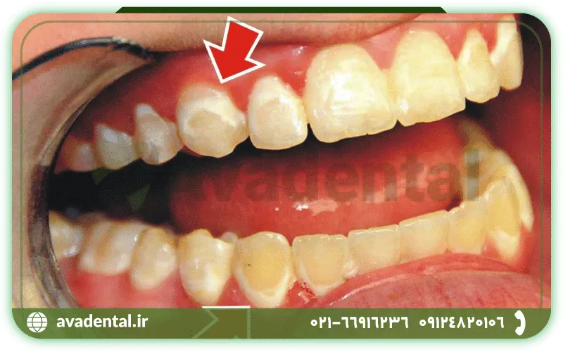 علت های تغییر رنگ دندان