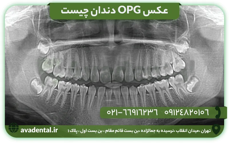 عکس OPG دندان چیست