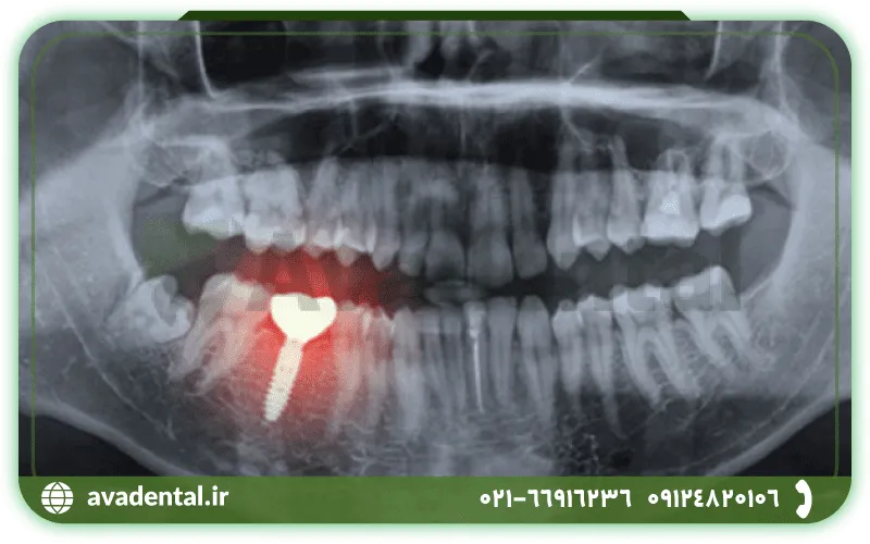 عکس OPG دندان چیست