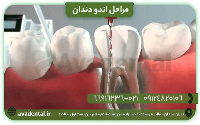 مراحل اندو دندان
