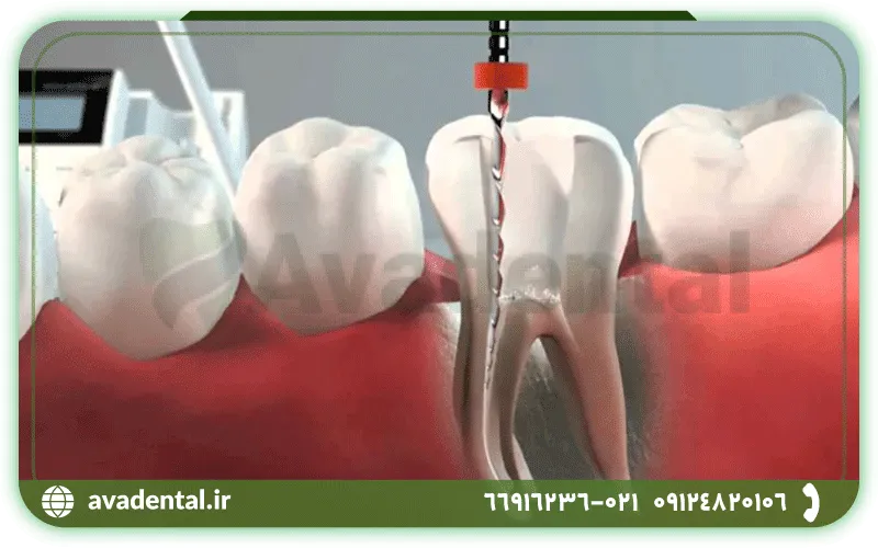 مراحل اندو دندان چیست