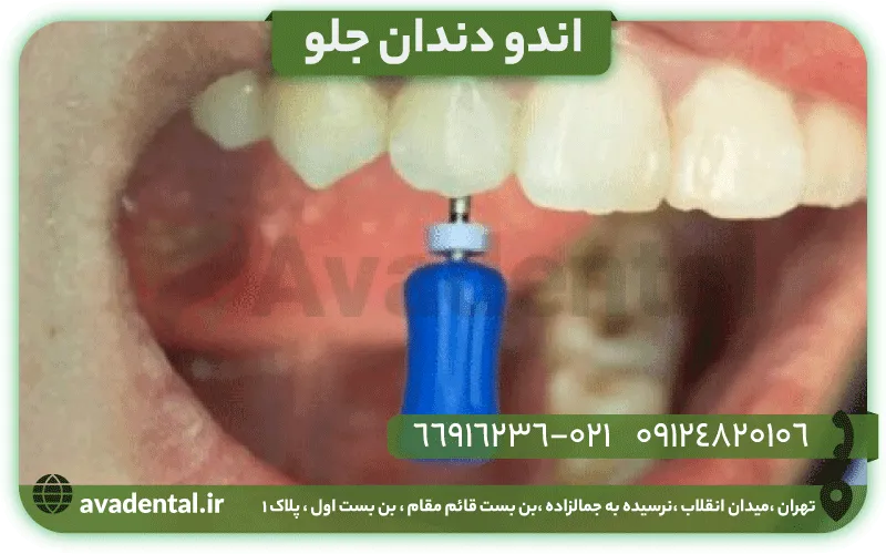 اندو دندان جلو