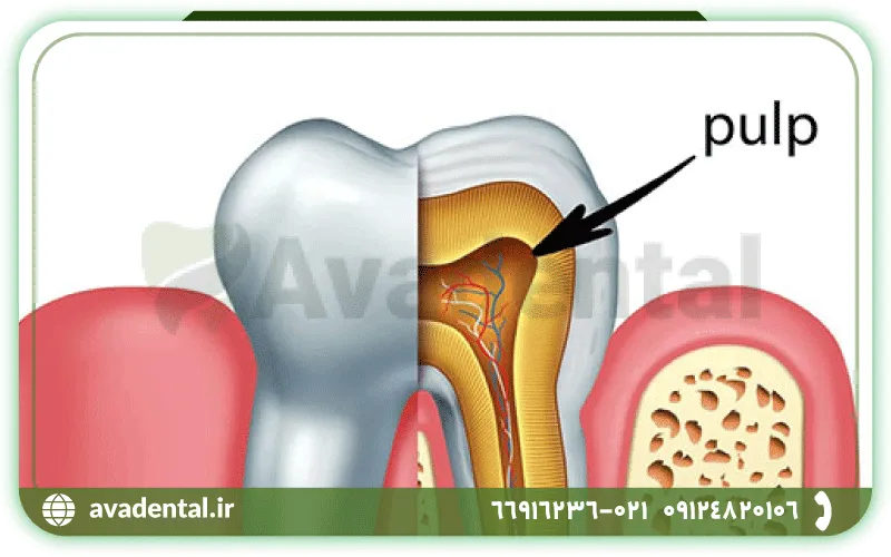 درمان ریشه یا پالپ دندان چیست