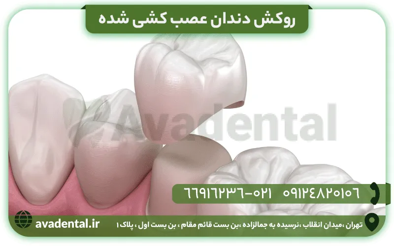 همه چیز درباره روکش دندان عصب کشی شده