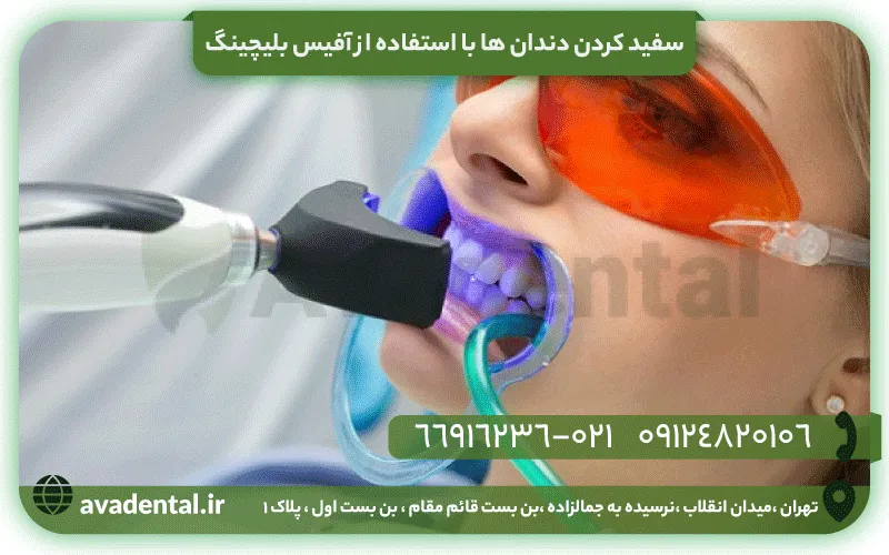 سفید کردن دندان ها با استفاده از آفیس بلیچینگ