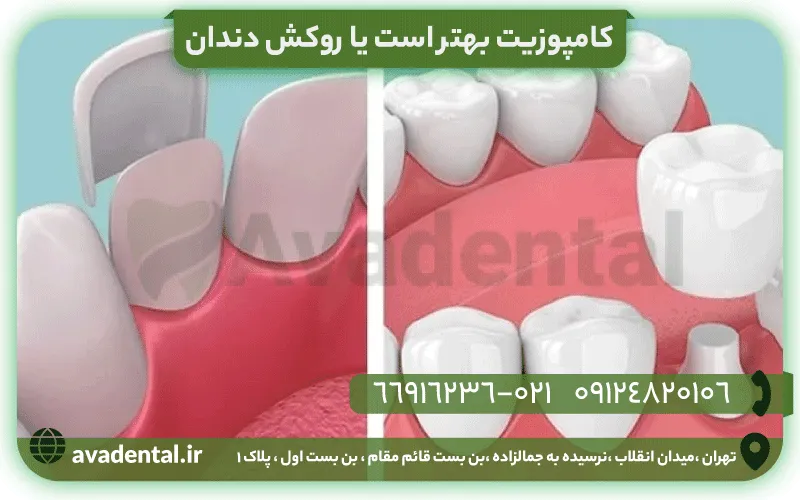 کامپوزیت بهتر است یا روکش دندان