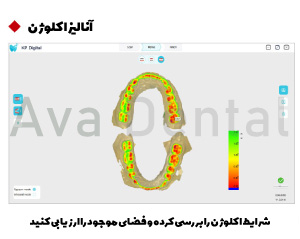 اسکنر داخل دهانی کوین پتر مدل Smile 2 11 آنالیز اکلوژن با اسکنر داخل دهانی اسمایل 2