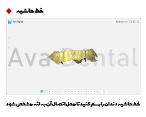 اسکنر داخل دهانی کوین پتر مدل Smile 2 8 ایجاد خط حاشیه در اسکنر داخل دهانی مدل SMILE2