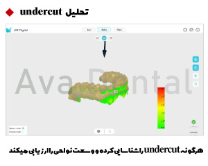 اسکنر داخل دهانی کوین پتر مدل Smile 2 9 تحلیل Undercut در اسکنر اسمایل 2 وودپیکر کوین پتر