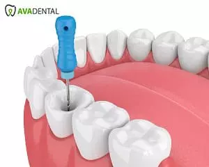 تجهیزات اندو دندانپزشکی
